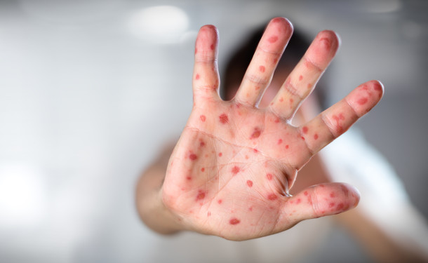 Официально: в Запорожье вспышка опасной инфекции, массово заражающая дети