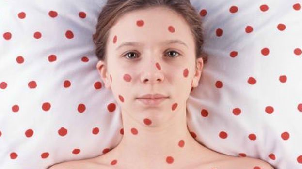 В Запорожской области зафиксировали очередной всплеск заболеваемости корью