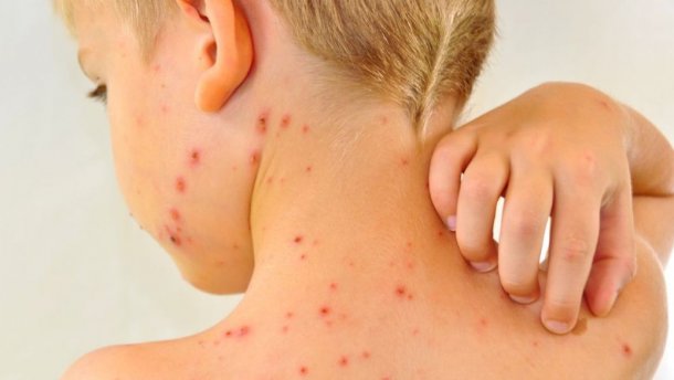 Корь атакует Запорожскую область: за неделю 19 больных