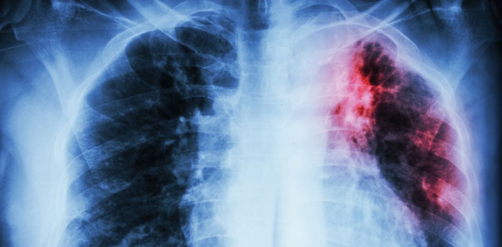 В Запорожской области более 1000 человек болеют активной формой туберкулеза