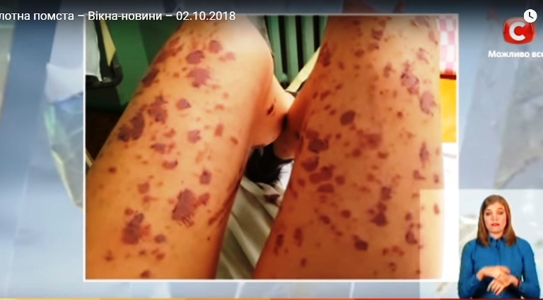 «Если ты не будешь моей, ты не будешь ничьей»: облитой кислотой запорожанке мстит бывший парень (ВИДЕО)