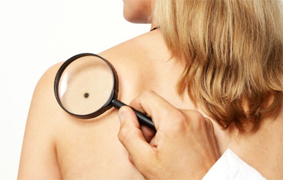 Бесплатные осмотры на наличие меланомы и рака кожи пройдут в Запорожье