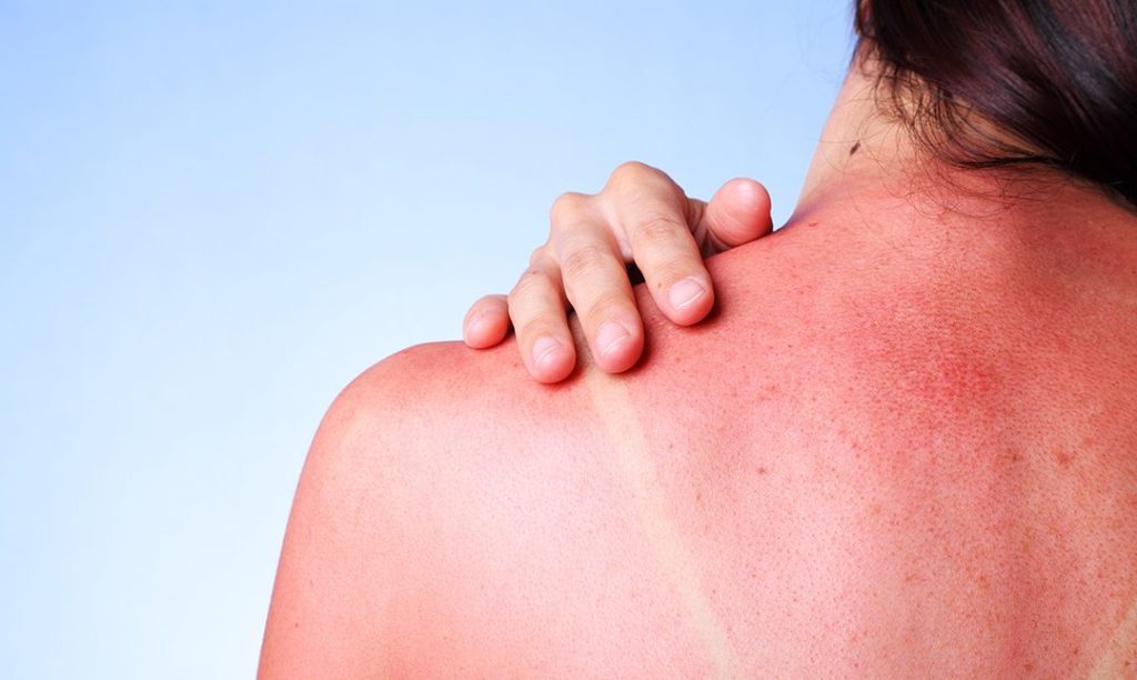 Без сметаны: дерматолог из Запорожской области рассказала, как спасаться от солнечных ожогов