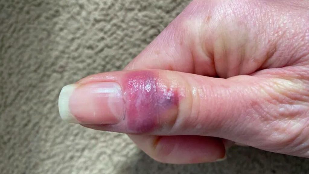 Ученые показали фото нового симптома COVID-19: как выглядит и у кого чаще встречается