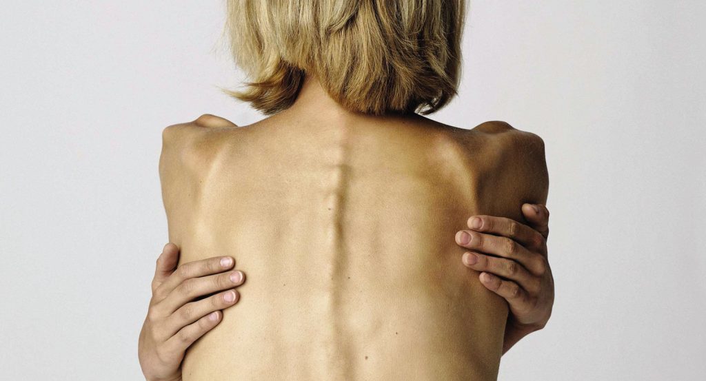 В Украине умерла 12-летняя девочка с весом 28 кг: подробности смертельного похудения