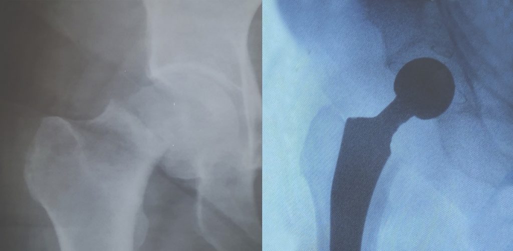 Запорожские ортопеды в кратчайший срок поставили на ноги сложную больную