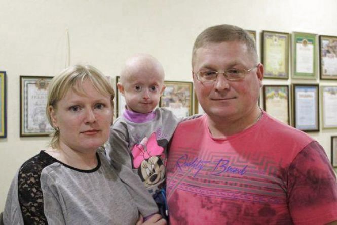 Ей было 10 лет и она умерла от старости: в Украине скончалась девочка с редкой болезнью